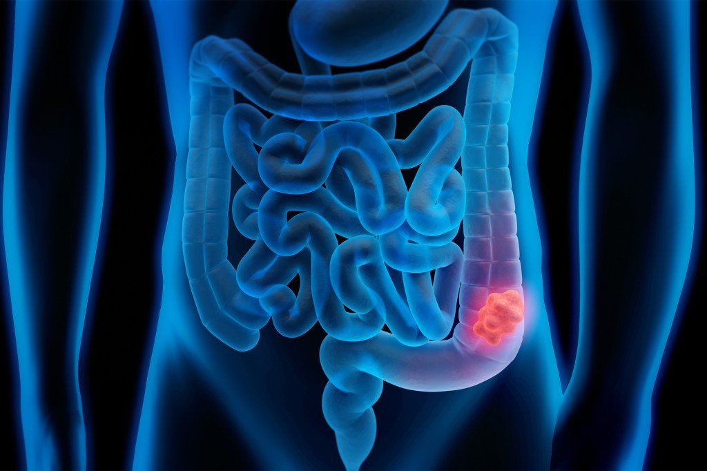 The US Preventive Services Task Force recommends that adults 45 to 75 years of age be screened for colorectal cancer. If you're younger, check with your doctor if you have a family history of colorectal cancer, inflammatory bowel disease, or troubling symptoms.